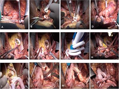 Systematic total arch replacement with thoraflex hybrid graft in acute type A aortic dissection: A single centre experience